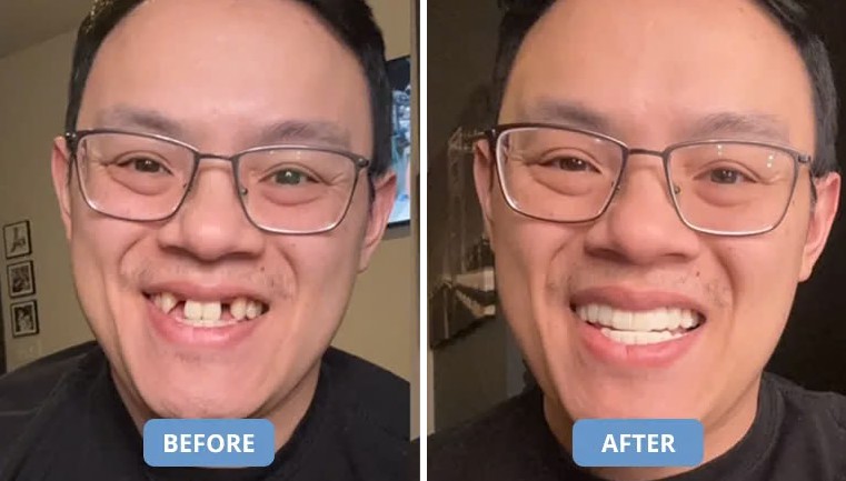 Split-screen promotional photo labeled Before and After: on the left a smiling man with gapped, uneven upper teeth; on the right the same man with a straighter, whiter smile.