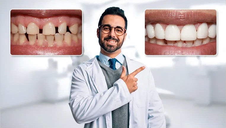 Manufacturer composite showing an impression being taken, a smiling person wearing veneers and a dentist